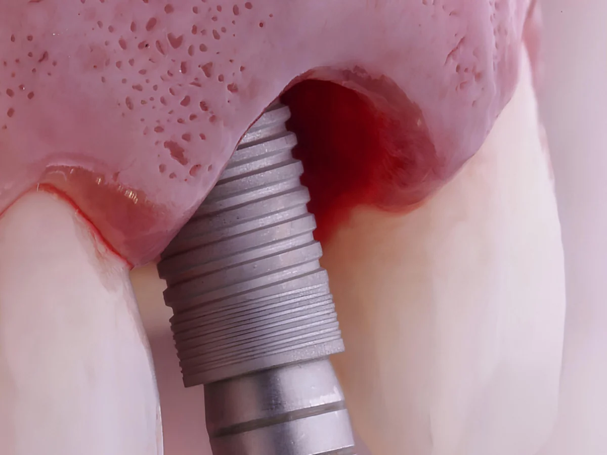 Sofort implant&aacute;ci&oacute;