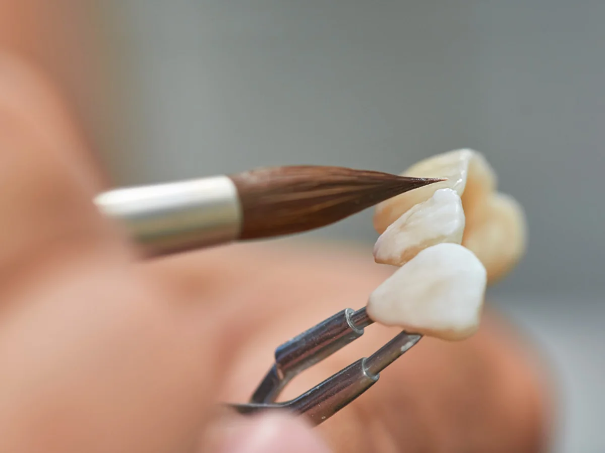 F&eacute;mmentes fog&aacute;szati koron&aacute;k