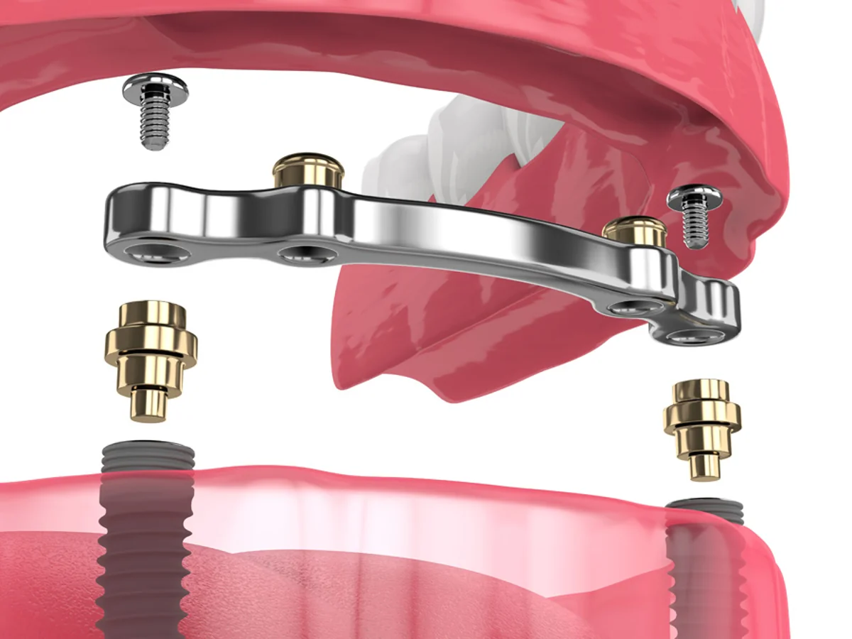 rejtett elhorgonyz&aacute;s&uacute; fogp&oacute;tl&aacute;s